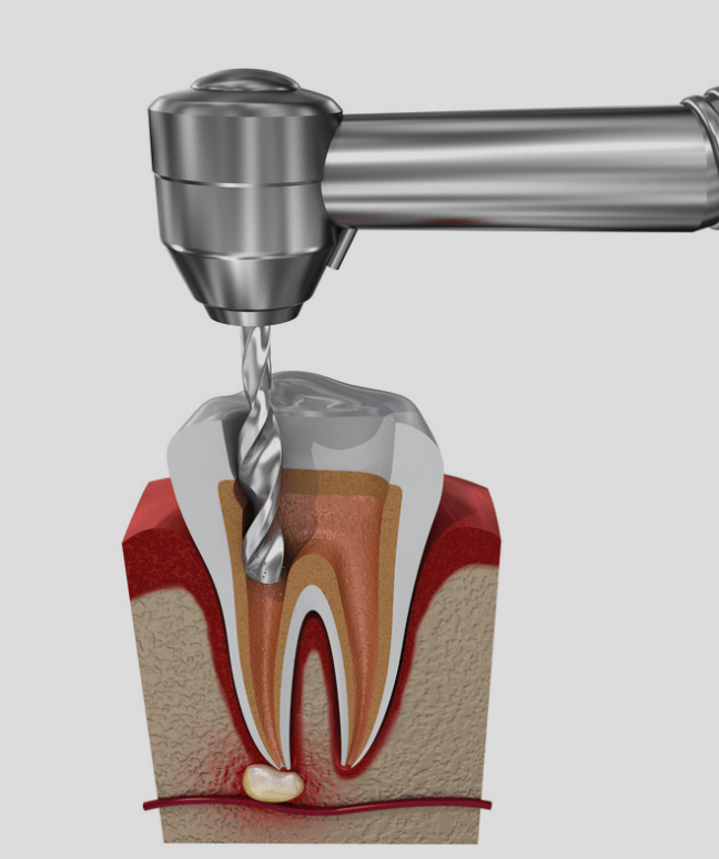 Root Canal Treatment - Sistova Road Dental Studio