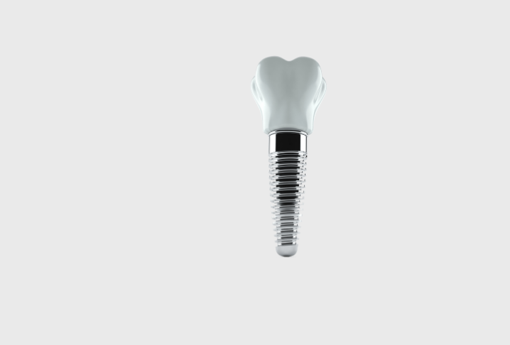 Dental Implant Treatments